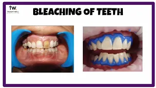 Bleaching of teeth | Tooth whitening explained!