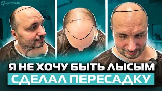 Мужская пересадка волос в Турции // Борьба с мужским облысением.