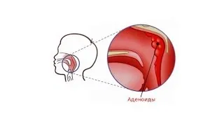 Нужно ли удалять аденоиды? Школа здоровья 01/02/2014 GuberniaTV