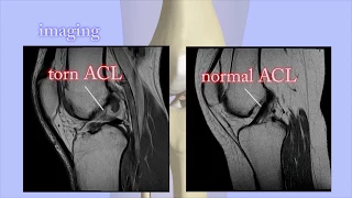 ACL Tears Diagnosis