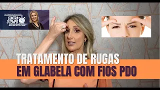 Tratamento das Rugas Glabelares com Fios PDO