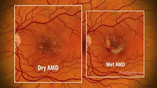 Macular Degeneration - an animated explanation