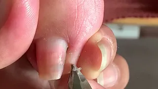 deep leg skin cutting technique#258