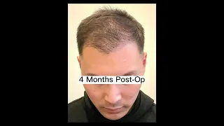 Hair Transplant Timeline 0-12 Months-Bogota Hairlines