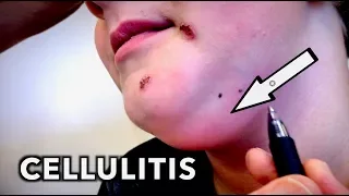 RARE CELLULITIS & Impetigo (Ultra Funny Kid) | Dr. Paul