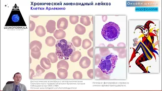 Хронический миелоидный лейкоз и хронический В-лимфоцитарный лейкоз. ТРЕЙЛЕР. Занятие №5 января 2023