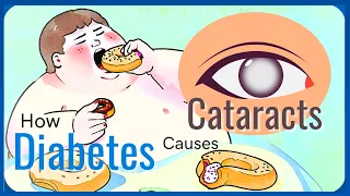Mechanism of Diabetic Cataract #biochemistry