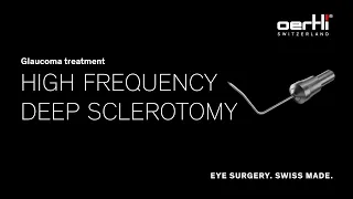 Spotlight: HFDS (High Frequency Deep Sclerotomy) | Glaucoma treatment