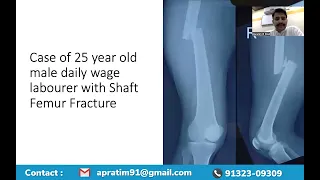 Case of 25 year old Male with Thigh bone fracture treated with Nailing of the thigh bone