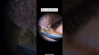 Stye Scab Removal