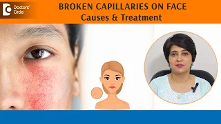 BROKEN CAPILLARIES on FACE! |Skin REDNESS | BLOOD VESSELS on face - Dr.Rasya Dixit | Doctors' Circle
