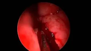 Endoscopic Septoplasty -Correction of a deviated septum