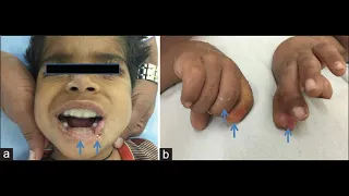 lesch nyhan syndrome #fmge #neet #pediatrics #trending #trending #mbbs #medicalexam #syndromes