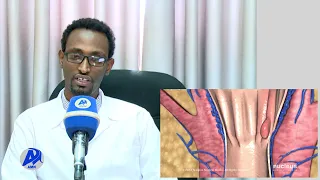 የኪንታሮት ህመም መንስኤና ህክምናው (ሐምሌ 23/2013 ዓ.ም)