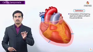 Cardiac Tamponade -- causes, ECG, Diagnosis, Pathology, Clinical findings, Treatment