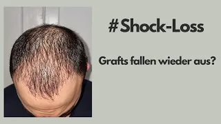 Shock Loss - Implantierte Grafts fallen wieder aus? |#9