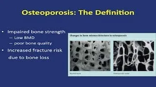 Save Your Bones: Osteoporosis Update 2014 - Research on Aging