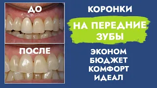 Коронки на передние зубы. Стоимость. Виды.