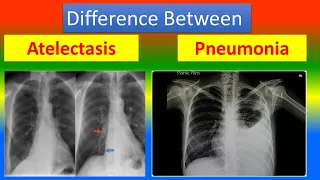 Difference between Atelectasis and Pneumonia