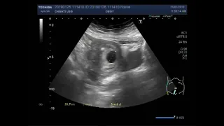 Ultrasound Video showing a Gestational sac in the uterus without a fetal pole in it.