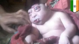 한 인도 여성, 기형아 낳자마자, 외계인이냐며 몇시간 동안 아기얼굴 안봐