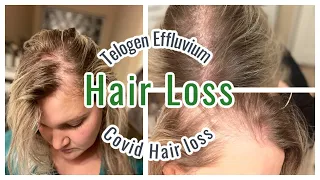 MY HAIR LOSS EXPERIENCE | TELOGEN EFFLUVIUM