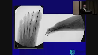 Common Foot Fractures - Kevin White, DO