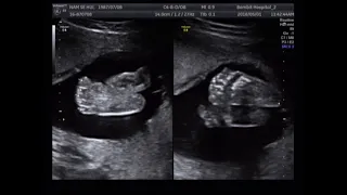 fetal ultrasound of 20 weeks 21 weeks baby boy moving