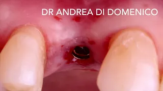 Management of Bone Defect with Prama Implant & OSSIX® Volumax