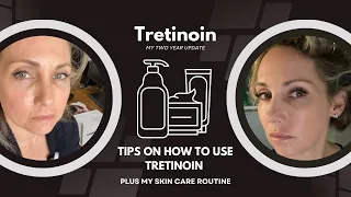 My Two Year Tretinoin Journey! Before and After (+plus videos form 10 years ago)