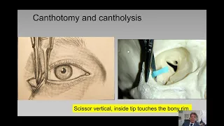 Emergency Canthotomy and Cantholysis -- The Essentials