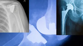 What is the most painful joint replacement surgery in 2023