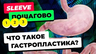 Что такое рукавная гастропластика? Методика операции Sleeve Gastrectomy. Уменьшение желудка.