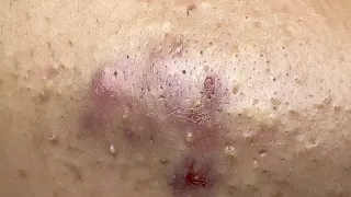 Inflammatory Acne P1 (Minh) | Mụn Viêm Tụ Máu P1 (MINH) - SacDepSpa#329