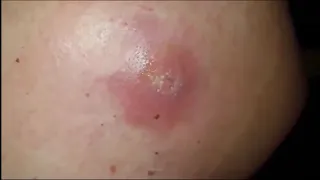 Most satisfying Pimple Popping moments 2020 - Part 13