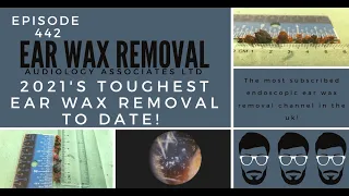 2021's TOUGHEST EAR WAX REMOVAL TO DATE - EP442