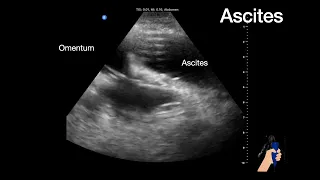 Ultrasound images of ascites