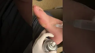 SATISFYING REMOVAL OF PLANTAR WART!😱 #shorts