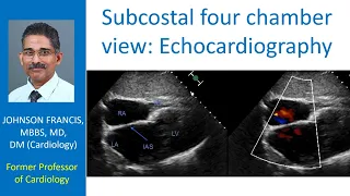Subcostal four chamber view – Echocardiography