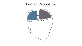 The Fontan Heart