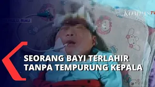 Kisah Bayi Usia 8 Hari yang Terlahir Tanpa Memiliki Tempurung Kepala, Butuh Uluran Tangan