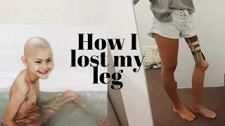 HOW I LOST MY LEG | From 9 year old kid to cancer to amputee.