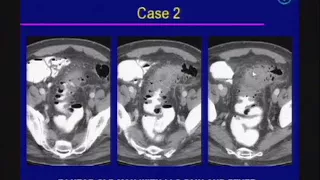 Acute Abdomen Imaging [Emergency Radiology]