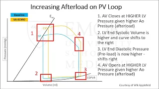 Unloading the Left Ventricle in Cardiogenic Shock Supported by VA-ECMO