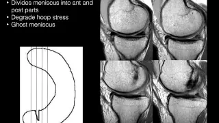 Knee Menisci by Geoffrey Riley, M.D.