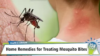 Home Remedies for Treating Mosquito Bites