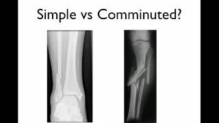 How to describe a fracture