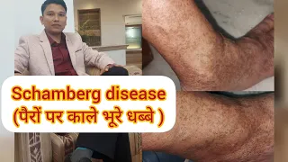 SCHAMBERG DISEASE टांगों में होने वाले धब्बे और निशान #skindiseases #pigmentation #spots #disease