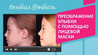 👄 Преображение улыбки и строения лица ребёнка от врача-ортодонта Дентал Фэнтези Наргизы Хамраевой