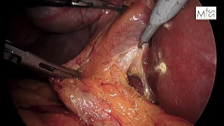 Colecistectomía laparoscópica (Cirugía de la vesícula biliar por colelitiasis)